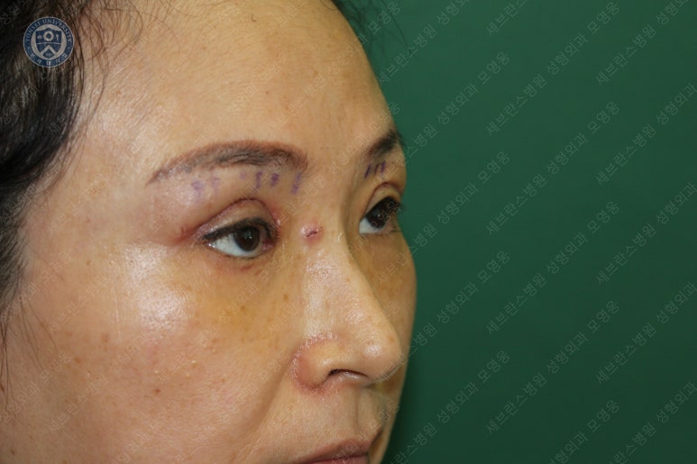 49세 여성, 토안이 있는 중년여성의 상안검성형술 (49/F, Upper blepharoplasty with lagophthalmos correction& LP) 관련 이미지 22