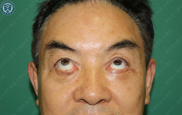 68세 남성, 하안검 성형술 및 안검외반 교정 증례(68/M Lower blepharoplasty & Ectropion correction with triamcinolone) 관련 이미지 8