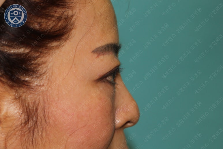 60세 여성, 상안검 및 하안검 성형술 증례 (60/F Upper & lower blepharoplasty) 관련 이미지 29