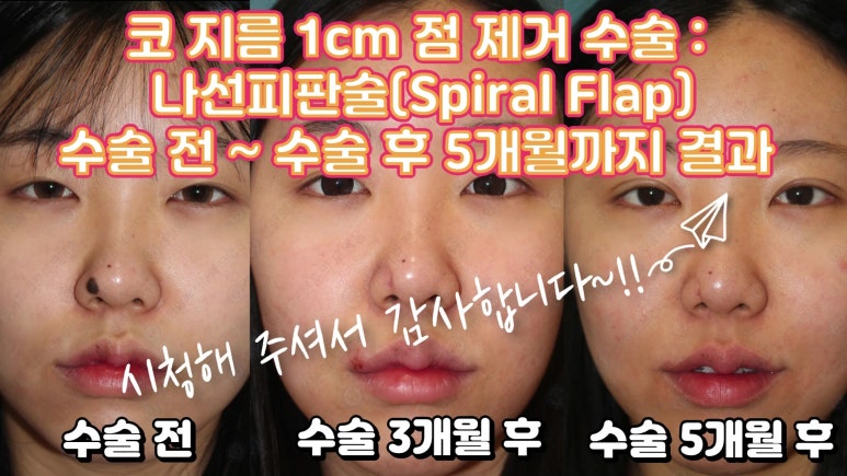 21세 여성 코 지름 1cm 점 제거수술 : 나선피판술(Spiral Flap) 수술전~5달 경과. (+쌍꺼풀수술, 코필러) 관련 이미지 84