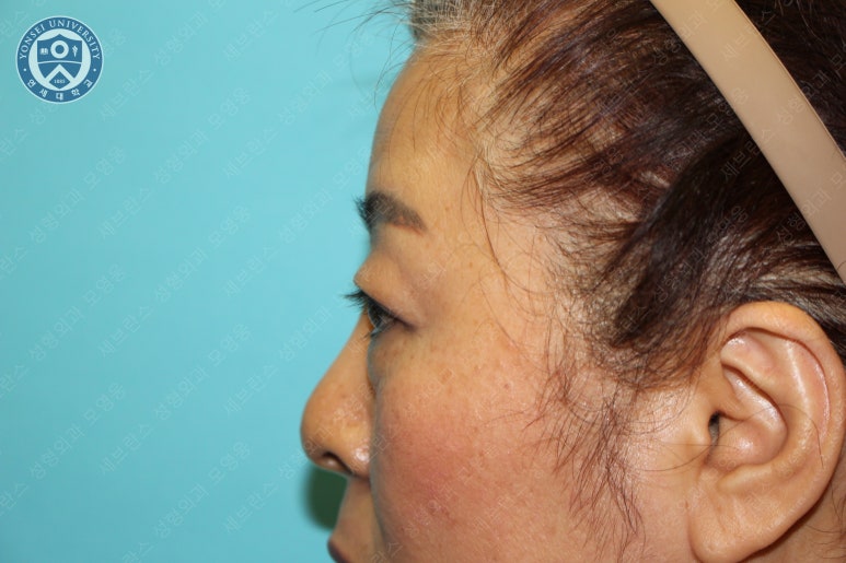 60세 여성, 상안검 및 하안검 성형술 증례 (60/F Upper & lower blepharoplasty) 관련 이미지 7