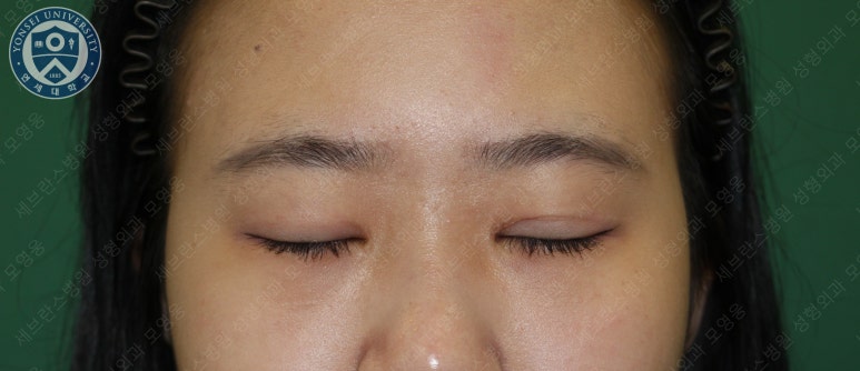 17세 여성, 비절개 눈매교정 및 앞트임 재수술 (17/F NI ptosis correction & Med. epicanthoplasty revision) 증례 관련 이미지 3