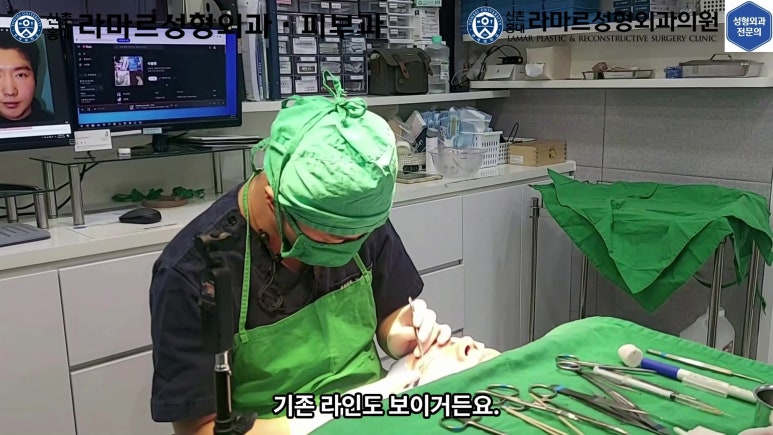 29세 남자, 소시지 쌍꺼풀 두줄따기로 낮추기 (쌍꺼풀 재수술) 관련 이미지 45