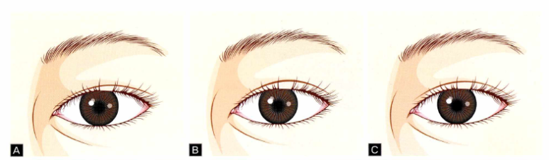 55세 여성, 상안검 및 하안검 성형술 증례 (55/F Upper & lower blepharoplasty) 관련 이미지 10