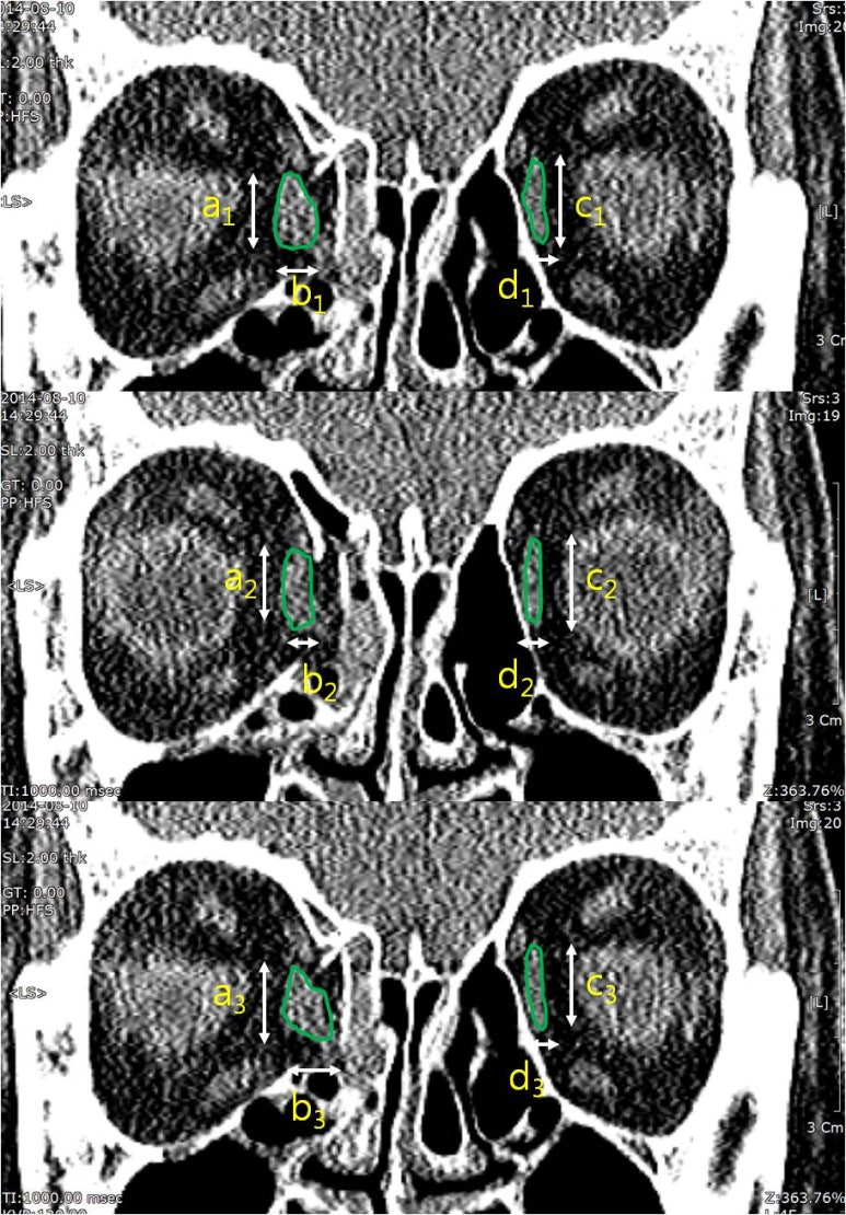 JPRAS-Prediction of late enophthalmos using quantitative measures in isolated med. orbital wall Fx. 관련 이미지 4