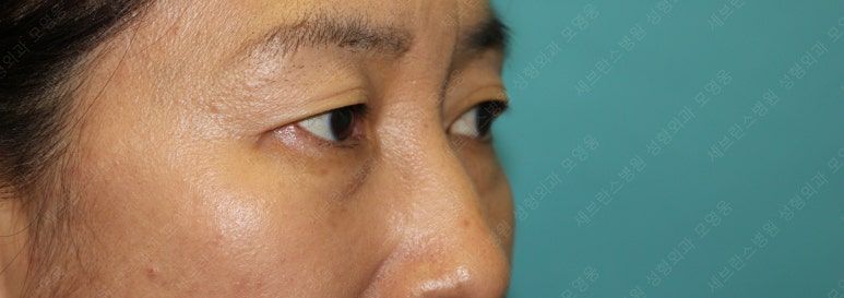 55세 여성, 상안검 및 하안검 성형술 증례 (55/F Upper & lower blepharoplasty) 관련 이미지 7
