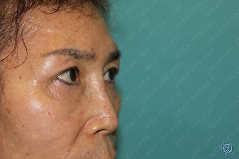 64세 여성 상안검성형술+눈매교정 (64/F Upper blepharoplasty with ptosis correction) 관련 이미지 32
