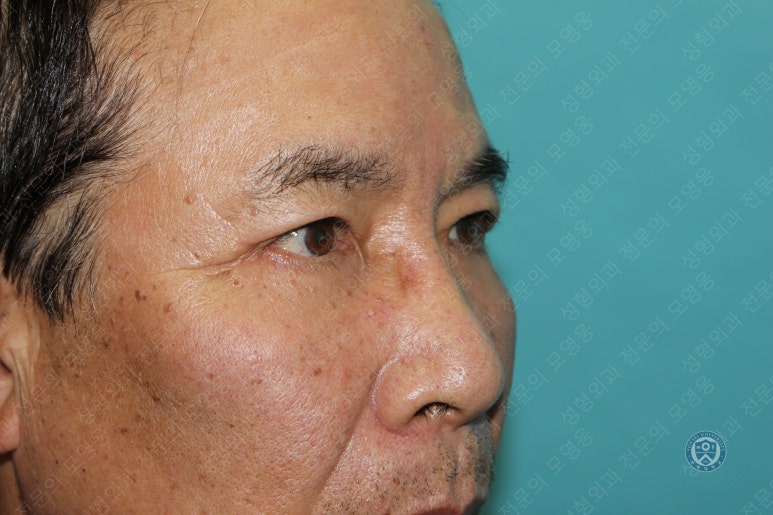 67세 남성, 상&middot;하안검성형술 및 안검하수교정 (67/M, Upper &  lower blepharoplasty with ptosis correction) 관련 이미지 42