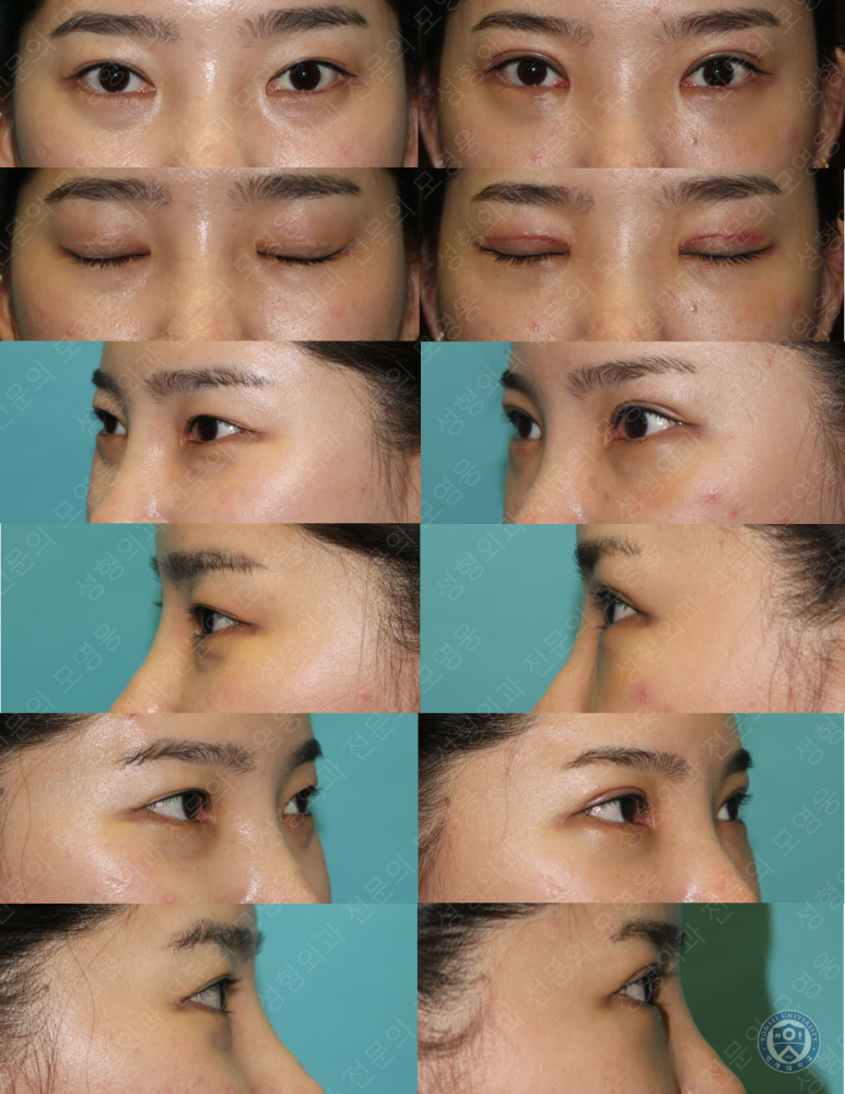 28세 여성 두줄따기, 눈밑지(28/F D.E.O & transconjunctival septal fat redraping) 관련 이미지 19