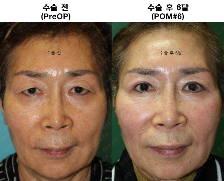 64세 여성 상안검성형술+눈매교정 (64/F Upper blepharoplasty with ptosis correction) 관련 이미지 42