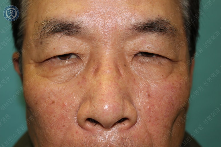 67세 남성, 상&middot;하안검성형술 및 안검하수교정 (67/M, Upper &  lower blepharoplasty with ptosis correction) 관련 이미지 8