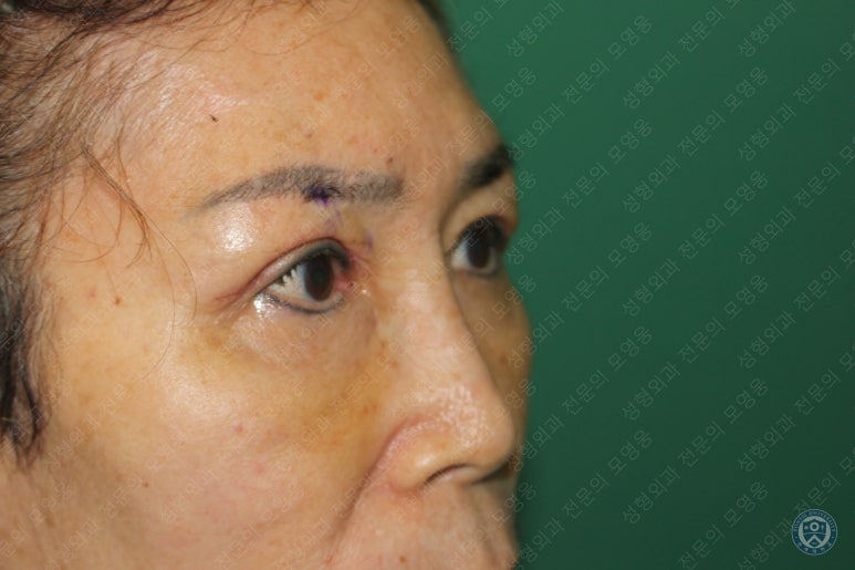 64세 여성 상안검성형술+눈매교정 (64/F Upper blepharoplasty with ptosis correction) 관련 이미지 16