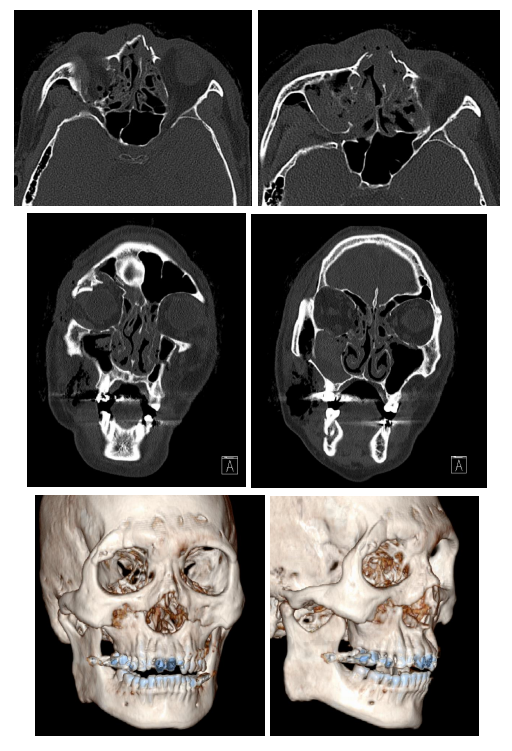 57세 남성, 얼굴 전체골절(57/M Panfacial bone fracture) 수술 및 흉터관리 증례 관련 이미지 4