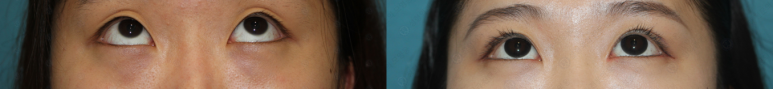 17세 여성, 쌍꺼풀+앞트임(DEO+Medial epicanthoplasty) 관련 이미지 55
