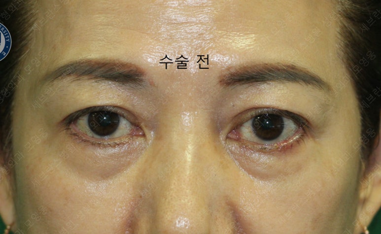 59세 여성, 그레이브스 안병증이 있는 돌출눈 중년 여성 하안검 성형술 (Lower blepharoplasty in Graves 관련 이미지 5