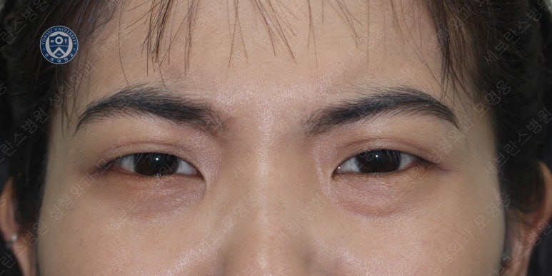 28세 여성, 눈밑지방재배치(눈밑지, 28/F Transconjunctival septal fat redraping-internal fixation technique) 관련 이미지 26