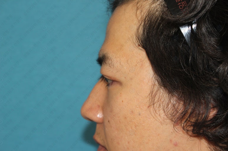 27세 남성 무쌍(속쌍)눈매교정 (27/M Ptosis correction with double lid plasty) 관련 이미지 25