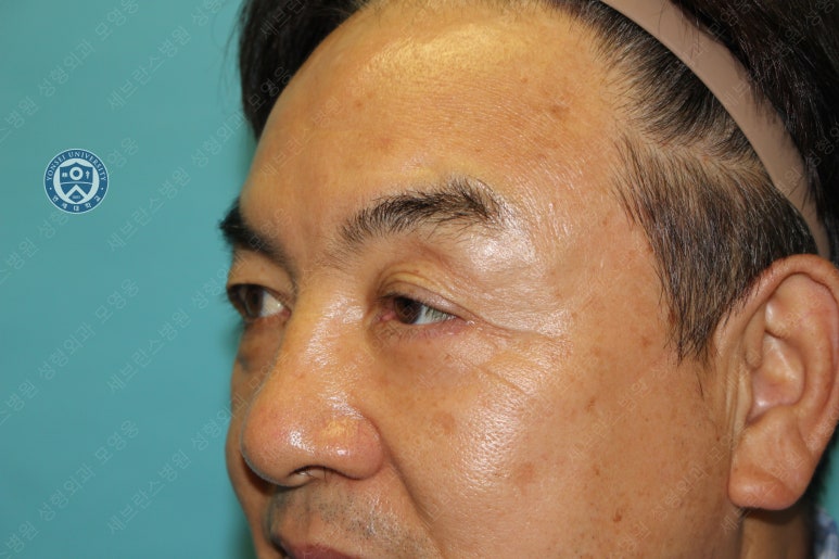 68세 남성, 하안검 성형술 및 안검외반 교정 증례(68/M Lower blepharoplasty & Ectropion correction with triamcinolone) 관련 이미지 21