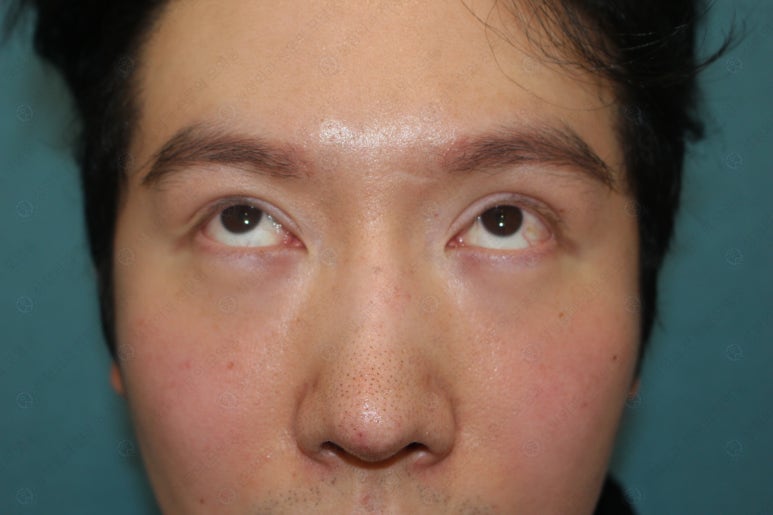 29세 남자, 소시지 쌍꺼풀 두줄따기로 낮추기 (쌍꺼풀 재수술) 관련 이미지 15