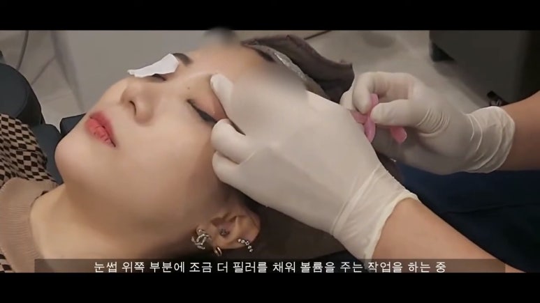 이마필러 : 21세 여성 이마필러 시술영상 관련 이미지 6