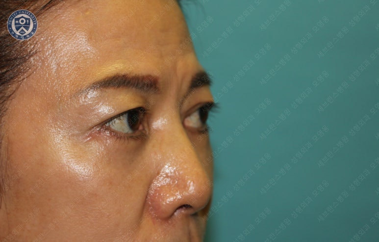 59세 여성, 그레이브스 안병증이 있는 돌출눈 중년 여성 하안검 성형술 (Lower blepharoplasty in Graves 관련 이미지 31
