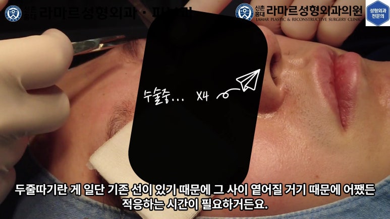 29세 남자, 소시지 쌍꺼풀 두줄따기로 낮추기 (쌍꺼풀 재수술) 관련 이미지 36