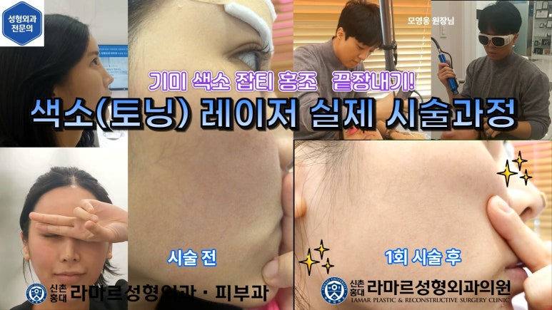 우리병원 토닝레이저 실제 시술과정 보여드립니다. 관련 이미지 5