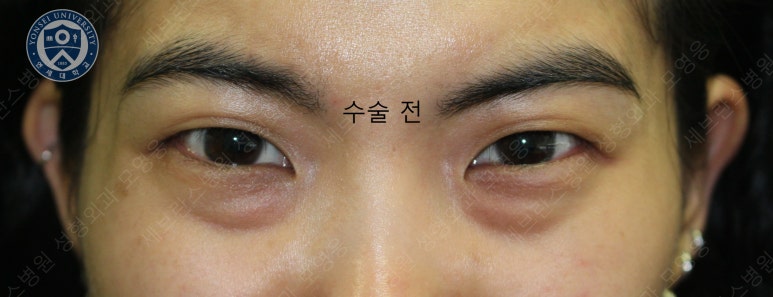 28세 여성, 눈밑지방재배치(눈밑지, 28/F Transconjunctival septal fat redraping-internal fixation technique) 관련 이미지 6
