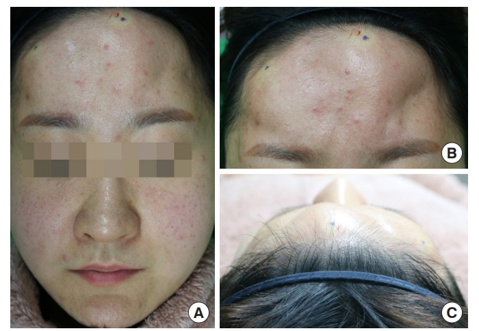 AAPS-Polyacrylamide hydrogel (Aquamid) filler removal after a decade 관련 이미지 7