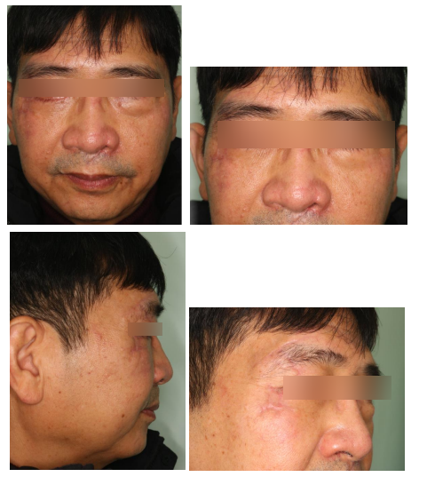 57세 남성, 얼굴 전체골절(57/M Panfacial bone fracture) 수술 및 흉터관리 증례 관련 이미지 16