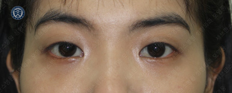 28세 여성, 눈밑지방재배치(눈밑지, 28/F Transconjunctival septal fat redraping-internal fixation technique) 관련 이미지 23