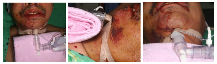 57세 남성, 얼굴 전체골절(57/M Panfacial bone fracture) 수술 및 흉터관리 증례 관련 이미지 7