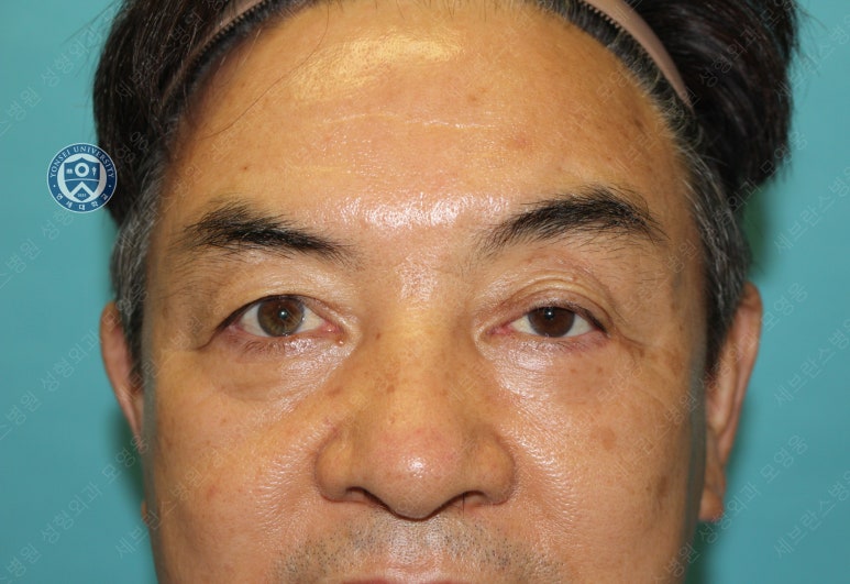 68세 남성, 하안검 성형술 및 안검외반 교정 증례(68/M Lower blepharoplasty & Ectropion correction with triamcinolone) 관련 이미지 16