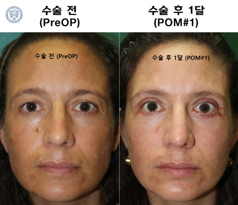 38세 서양 백인 여성, 쌍꺼풀 수술과 눈매교정 및 하안검성형술 (38/F Upper&lower blepharoplasty with levator plication) 관련 이미지 37