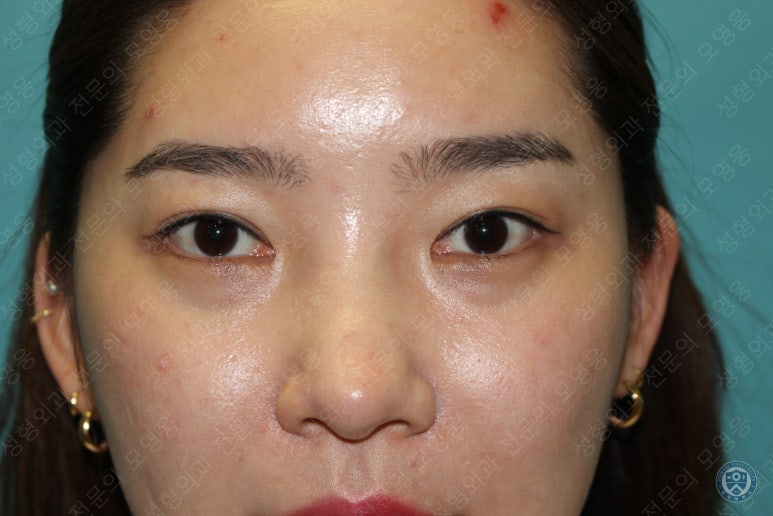 28세 여성 두줄따기, 눈밑지(28/F D.E.O & transconjunctival septal fat redraping) 관련 이미지 3