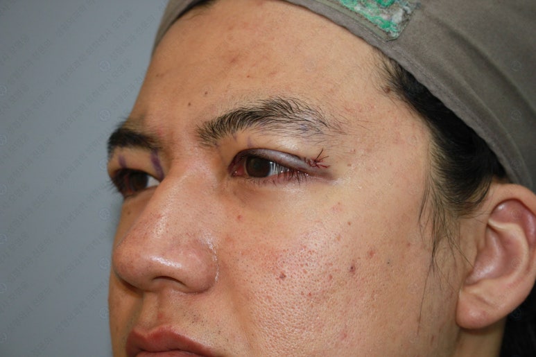 27세 남성 무쌍(속쌍)눈매교정 (27/M Ptosis correction with double lid plasty) 관련 이미지 18