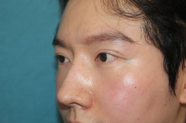 29세 남자, 소시지 쌍꺼풀 두줄따기로 낮추기 (쌍꺼풀 재수술) 관련 이미지 18