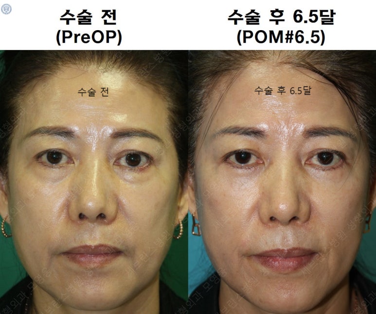 59세 여성, 그레이브스 안병증이 있는 돌출눈 중년 여성 하안검 성형술 (Lower blepharoplasty in Graves 관련 이미지 41