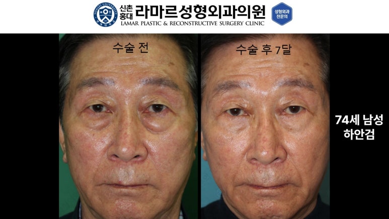 30대~80대 눈 수술 케이스 : 하안검성형술 전후 사진 모음 관련 이미지 35