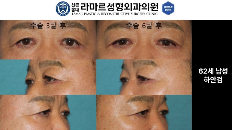 30대~80대 눈 수술 케이스 : 하안검성형술 전후 사진 모음 관련 이미지 10