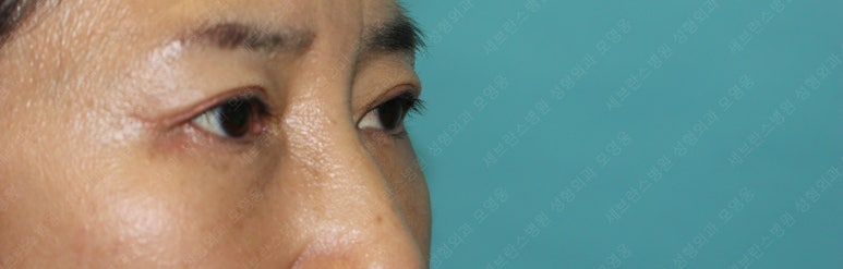 55세 여성, 상안검 및 하안검 성형술 증례 (55/F Upper & lower blepharoplasty) 관련 이미지 25