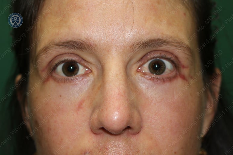 38세 서양 백인 여성, 쌍꺼풀 수술과 눈매교정 및 하안검성형술 (38/F Upper&lower blepharoplasty with levator plication) 관련 이미지 30
