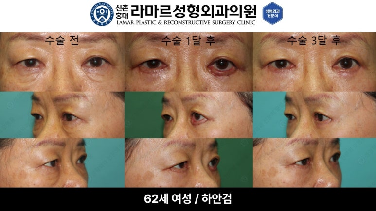 30대~80대 눈 수술 케이스 : 하안검성형술 전후 사진 모음 관련 이미지 54