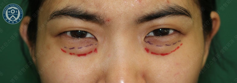 28세 여성, 눈밑지방재배치(눈밑지, 28/F Transconjunctival septal fat redraping-internal fixation technique) 관련 이미지 15
