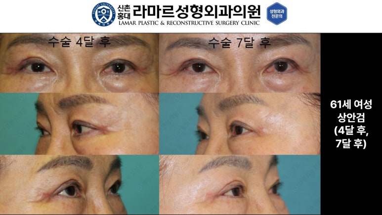 40대~80대 눈 수술 케이스 : 상안검성형술 전후 사진 모음 관련 이미지 26