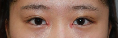17세 여성, 쌍꺼풀+앞트임(DEO+Medial epicanthoplasty) 관련 이미지 14