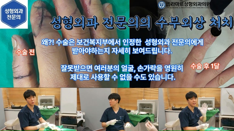 손가락 힘줄 손상 및 열상, 손톱 바닥 열상 처치 (Extensor tendon repair and nailbed injury treatment) 관련 이미지 5