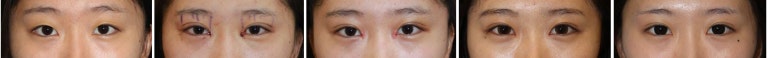 17세 여성, 쌍꺼풀+앞트임(DEO+Medial epicanthoplasty) 관련 이미지 39