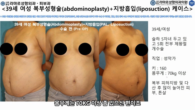 '복부성형술+지방흡입(Abdominoplasty+PAL)' 으로 뱃살 끝장내기! 관련 이미지 30