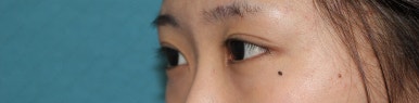 17세 여성, 쌍꺼풀+앞트임(DEO+Medial epicanthoplasty) 관련 이미지 35